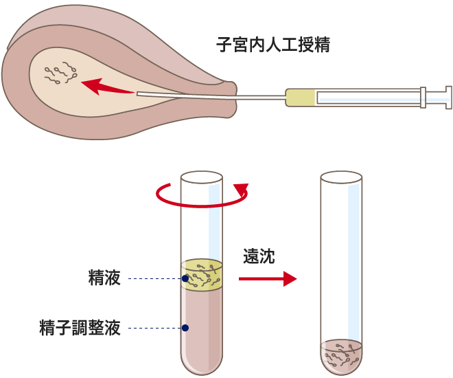 人工授精